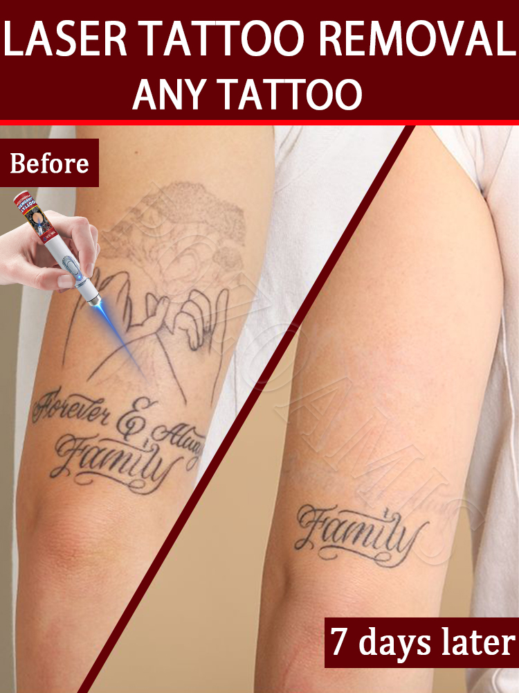 Nano laser tattooʀᴇᴍᴏᴠᴀʟ ᴘᴇɴ:  - Laser Toner Powder review and price